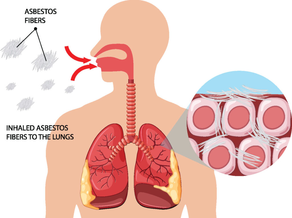 Mesothelioma